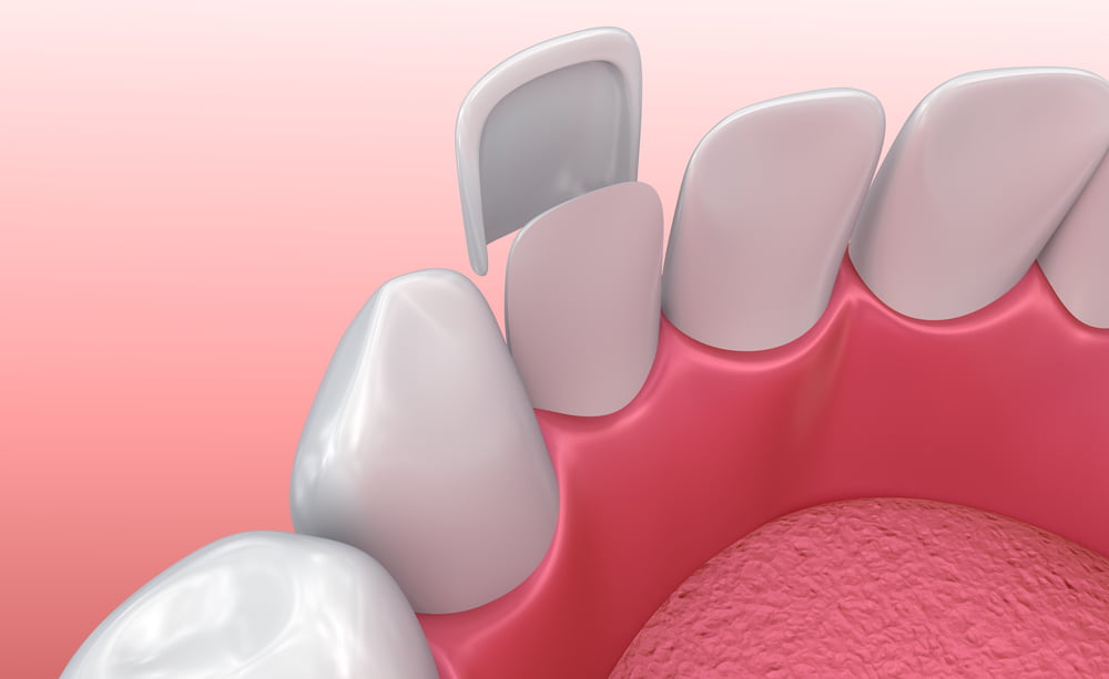 What is the Difference Between Veneers and Lumineers?