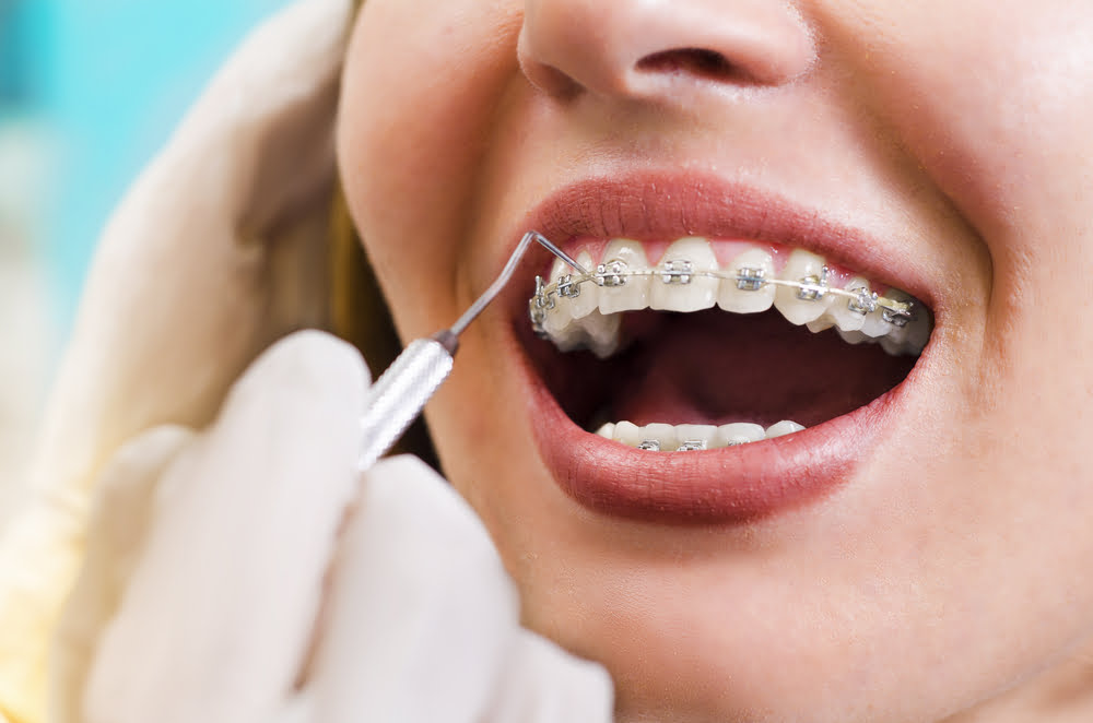 Dental Braces: Their Benefits and Risks