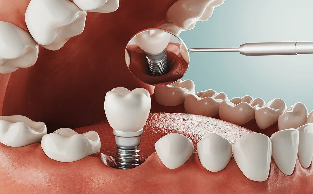 All-On-4 Dental Implants