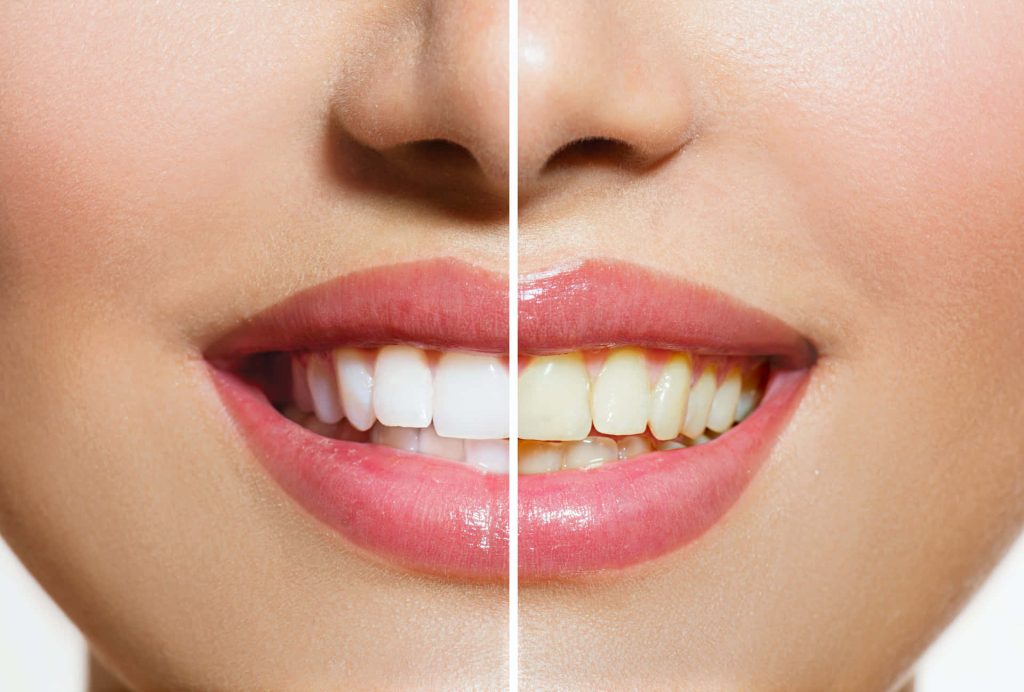 What Are the Different Types of Teeth Whitening?