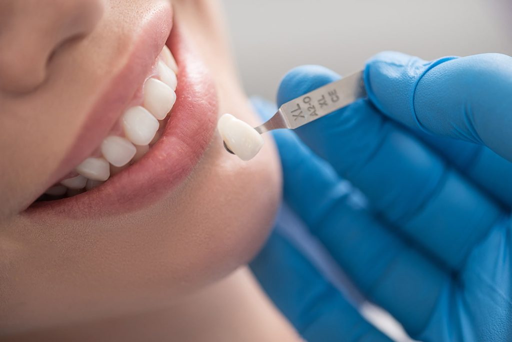 What Are the Stages of the Dental Veneer Procedure?