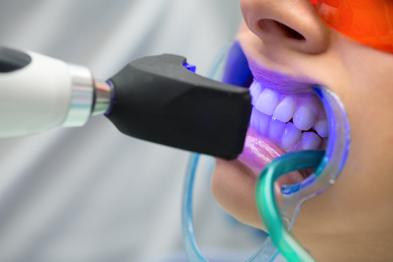 All You Need to Know About Laser Teeth Whitening