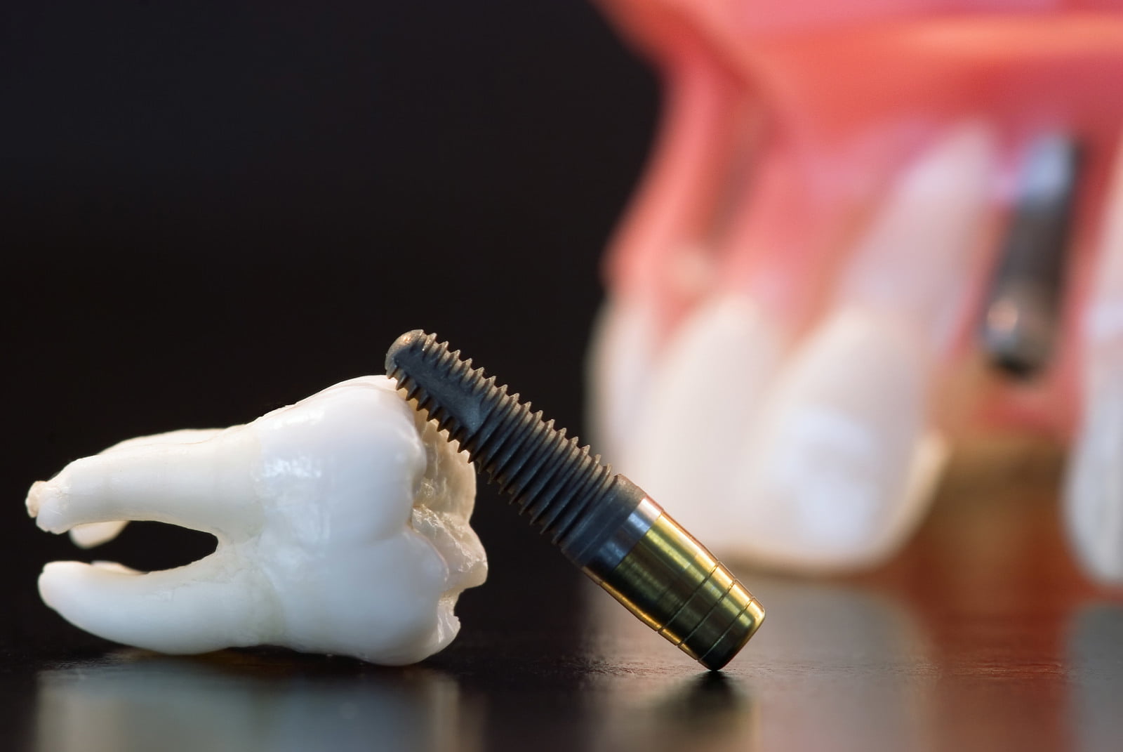 The Future of Dental Implants Using Stem Cells