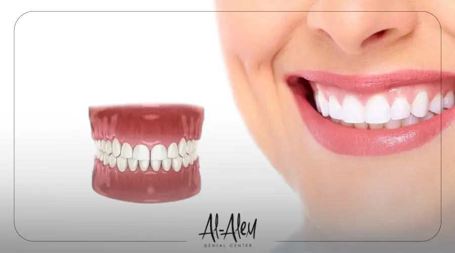 افضل انواع زراعة الاسنان