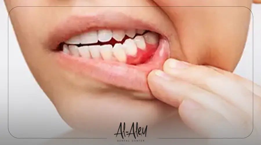علاج انتفاخ اللثة في الفك السفلي