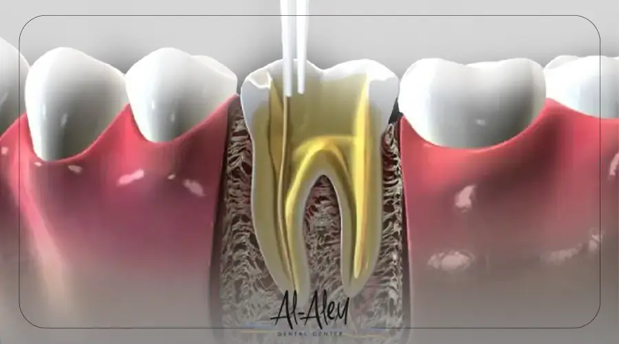 علاج عصب الضرس المكشوف