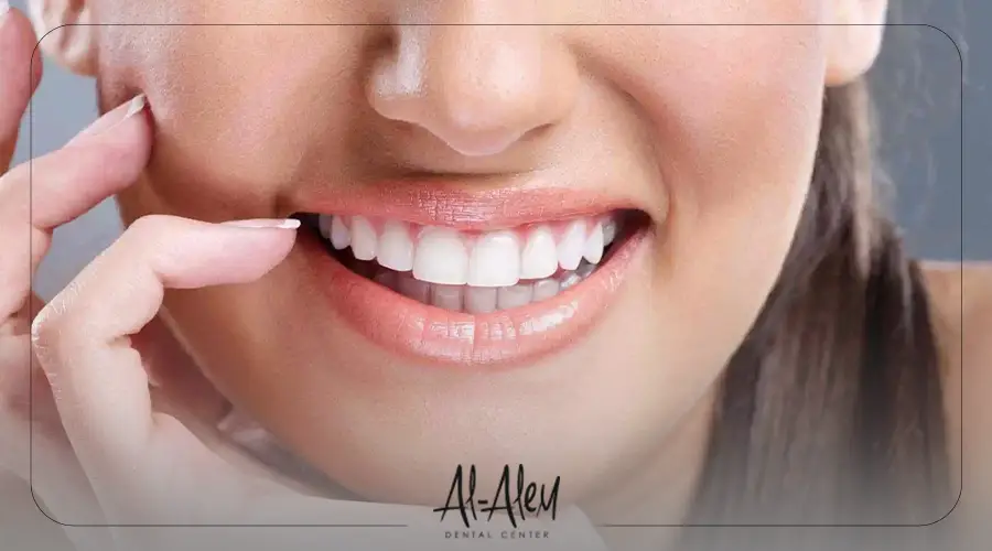 تركيب فينير الاسنان الثابت