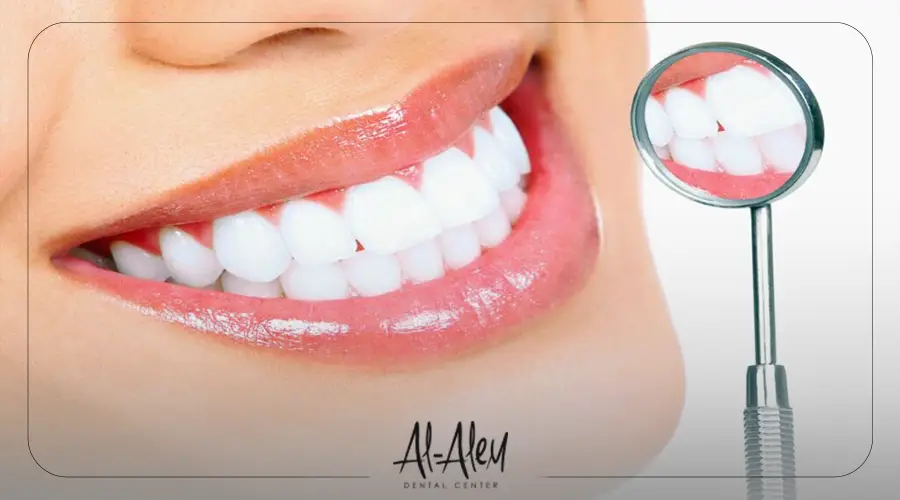 تكلفة كومبوزيت فينير