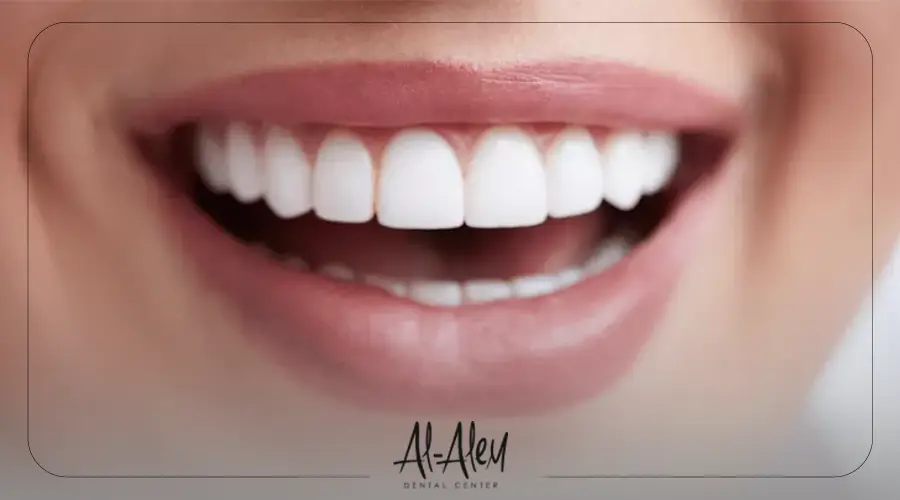 ما هو فينير الاسنان