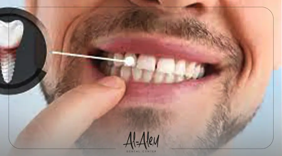 موانع زراعة الاسنان