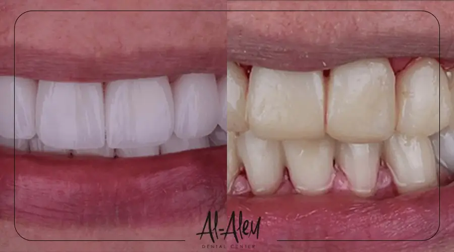 عمليات تجميل الاسنان قبل وبعد