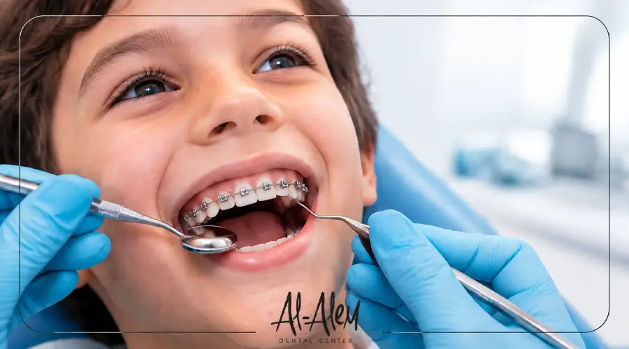 أنواع تقويم الأسنان للاطفال