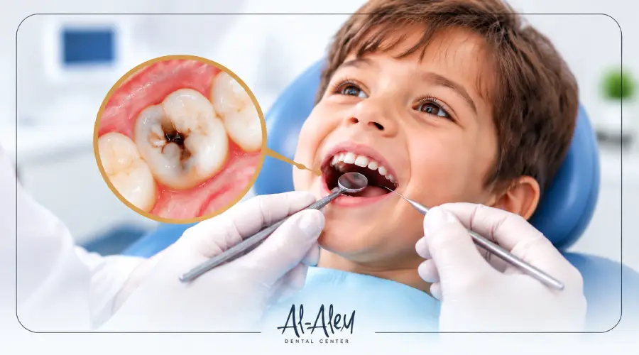 علاج تسوس الأسنان عند الأطفال